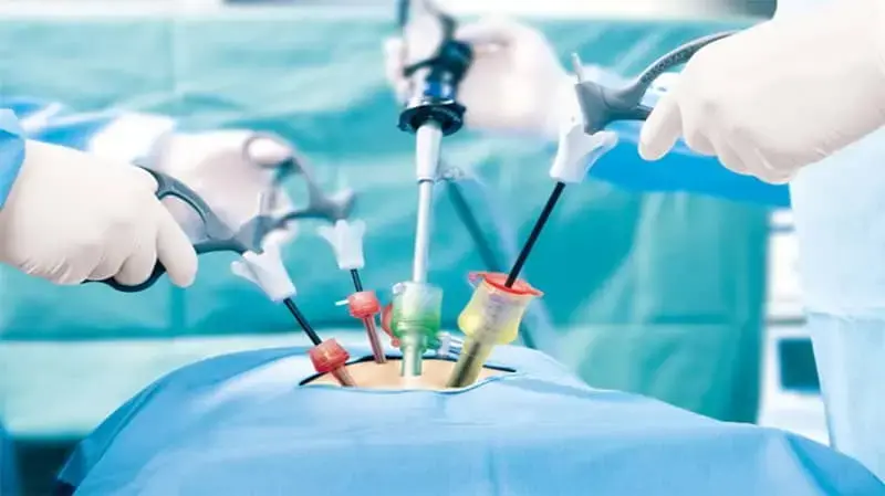 What Happens During an Appendix Removal Surgery