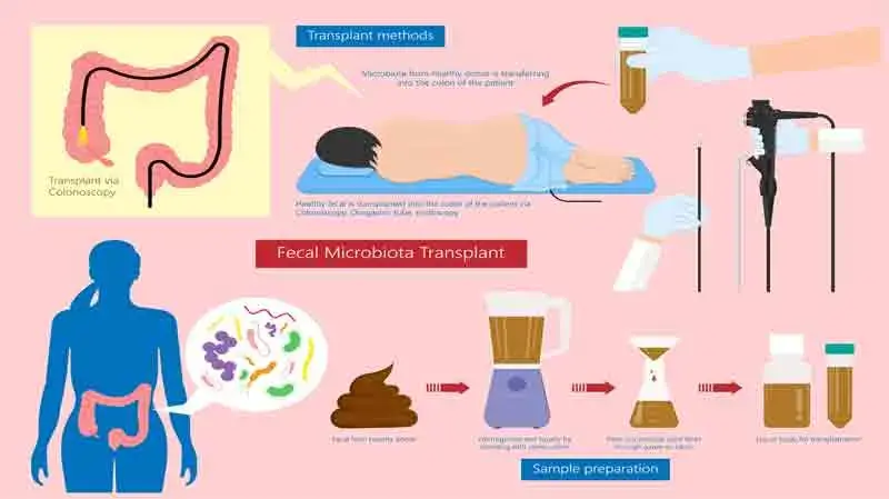 Faecal Microbiota Transplant (FMT) - A Revolutionary Approach to Gut Health