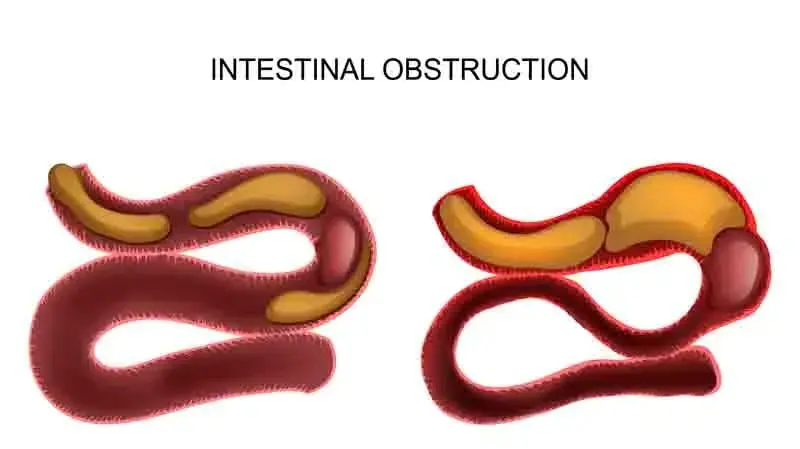can glp 1 cause bowel obstruction Does GLP-1 Colon Cancer? Evidence and FDA Data Gastrointestinal effects of GLP-1 receptor