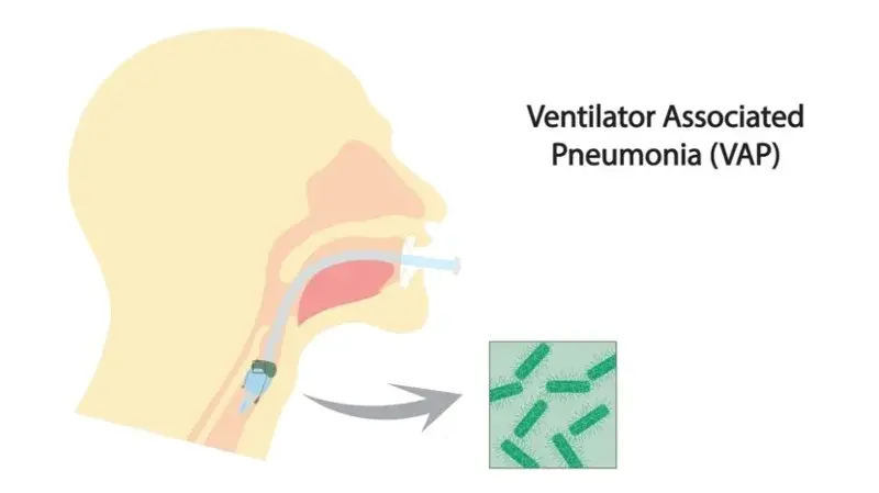 Ventilator-associated pneumonia (VAP)