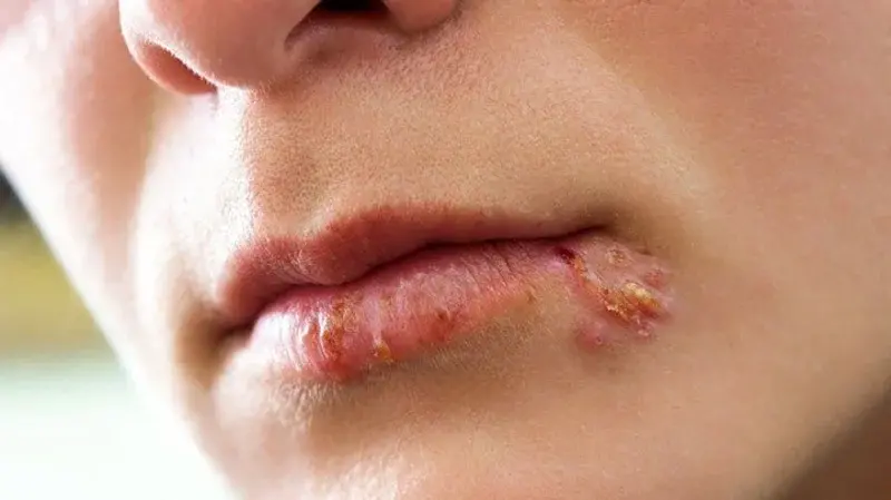 glp 1 and cold sores Herpes Simplex Virus 1 & 2 Abreva Docosanol 10 Percent Cold