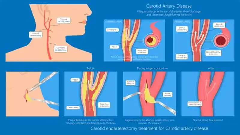 The Role of Endarterectomy in Treating Carotid Artery Disease