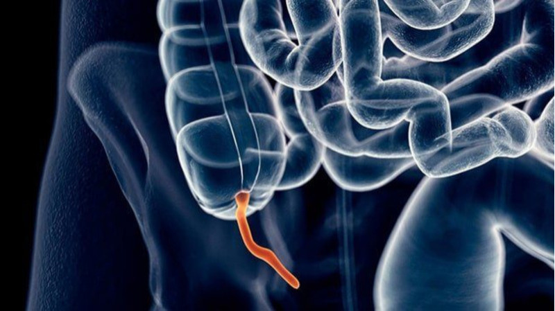 glp 1 appendicitis TrimRX Most Appendicitis Patients See Good