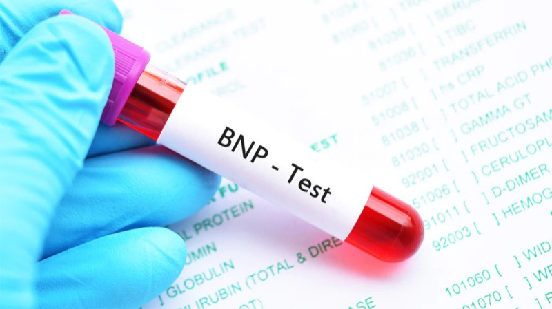 What Is a BNP Test, Results, Normal, High, and Levels