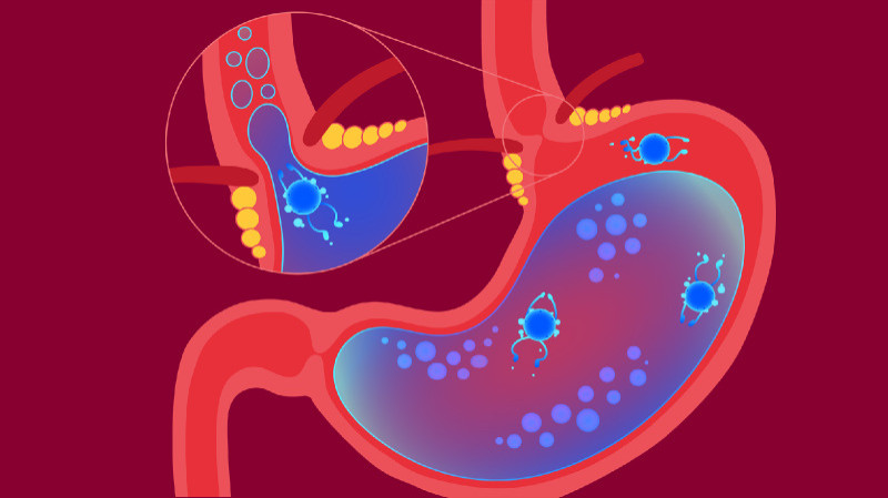 bpc 157 barrett's esophagus Barrett's esophagus main image 1