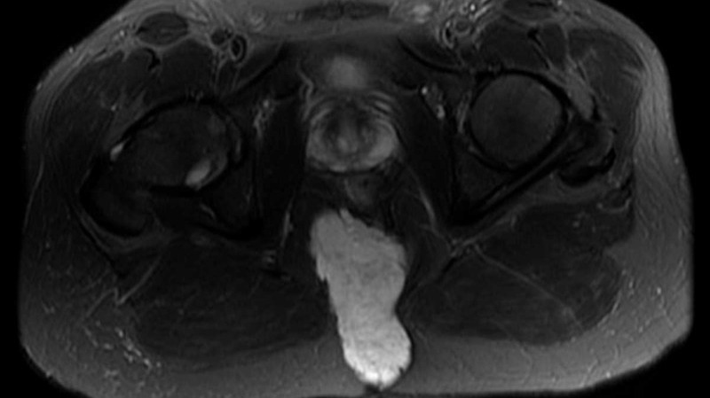 Chordoma - Causes, Symptoms and Treatment Options