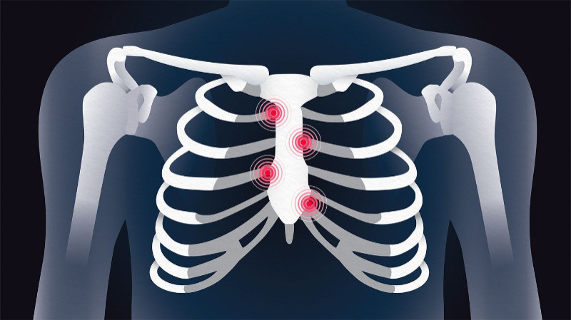 costochondritis and smoking cigarettes Recently told I have costochondritis.. looking for some hope reassurance : r/costochondritis Costochondritis: Symptoms, Causes, and Treatment