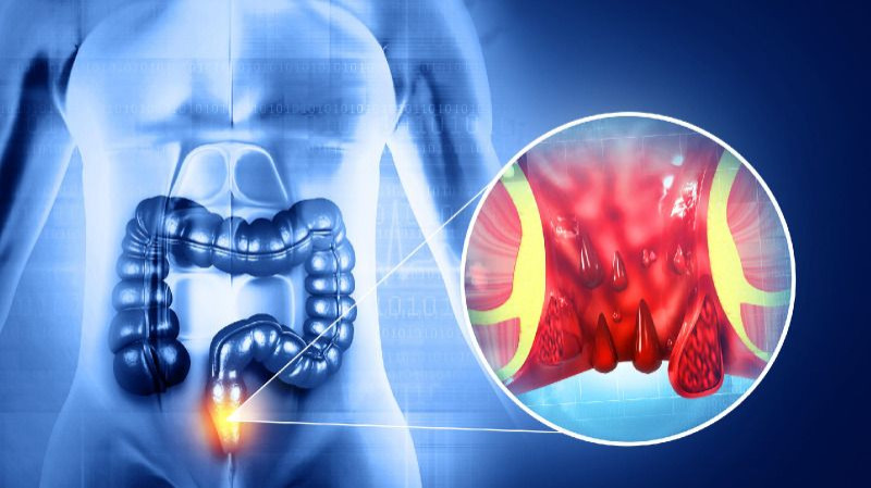 hemorrhoids from glp 1 glp-1 and A Closer Look at the Dermatological Profile of GLP-1 Agonists and hemorrhoids Relevance  Hemorrhoids & Treatment Options -