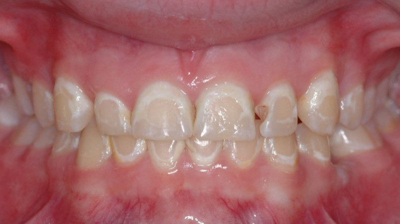 metallic taste in mouth after b12 injection Metallic Taste in Mouth