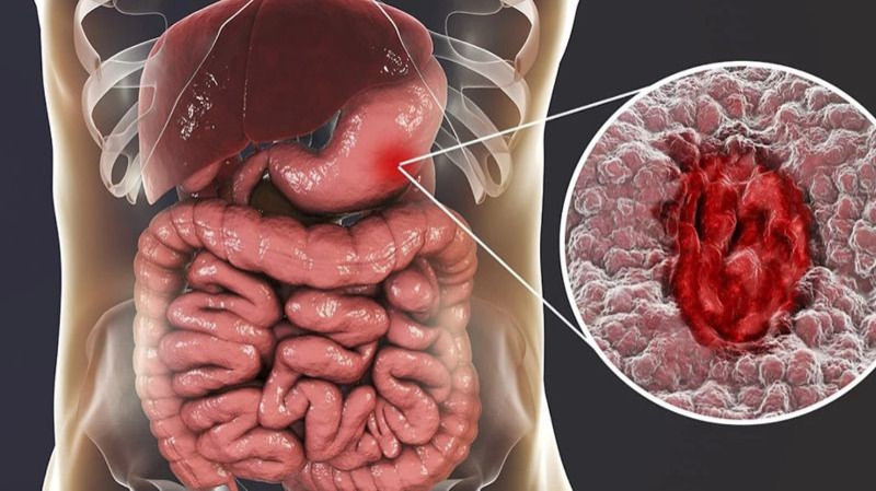 can glp 1 cause ulcers Duodenal Ulcer Treatment Options for Peptic Ulcer