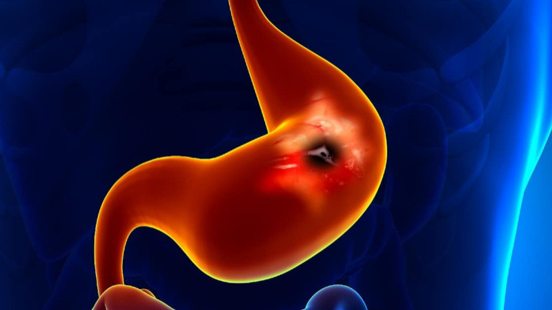 can glp 1 cause ulcers Exploring the Side Effects of GLP-1 Receptor Agonist: To Ensure Its Optimal Positioning GLP-1RA Essentials in Gastroenterology: Side