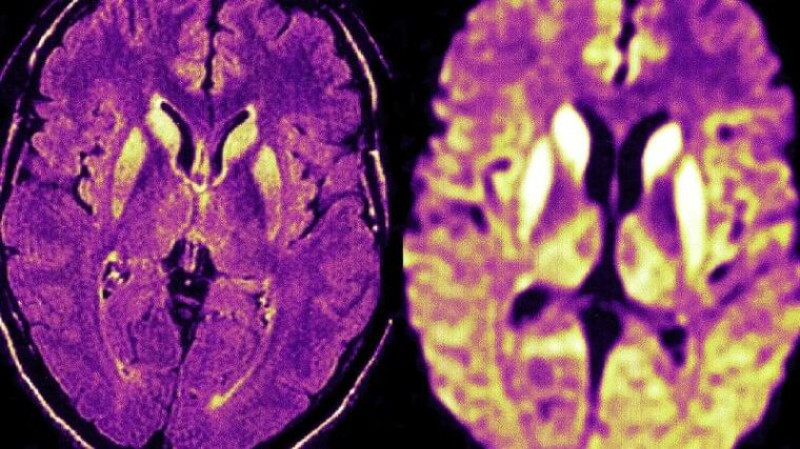 Prion Disease: Symptoms, Causes, Treatment and Prevention