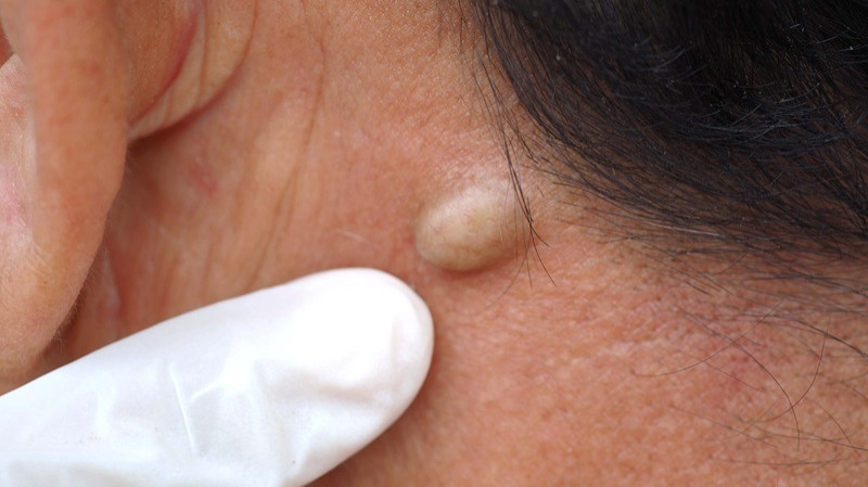 Sebaceous Cyst: Causes, Diagnosis, and Treatment