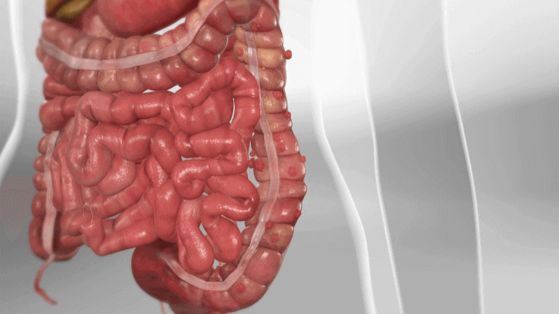 diverticulitis glp-1 Semaglutide & Diverticulitis: A Complete Overview 4 vitamins to avoid with
