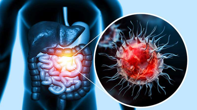 Colorectal Cancer: Causes, Symptoms, and Treatment Options | Narayana Health