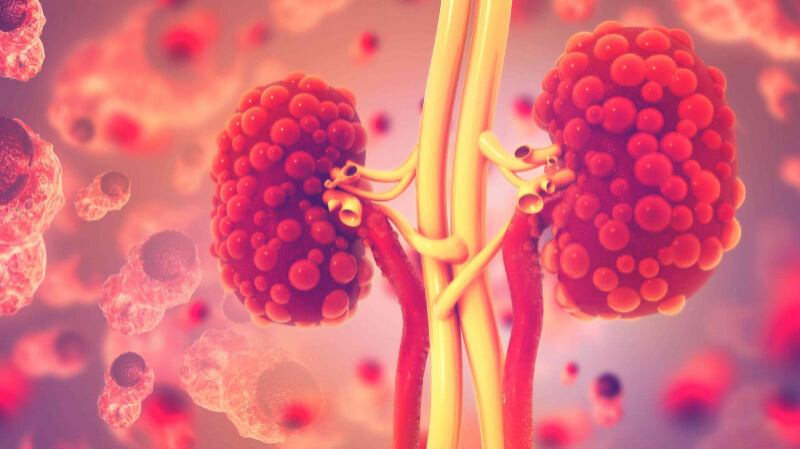 glp 1 polycystic kidney disease GLP-1 receptor agonists in ADPKD: from metabolic rationale to phenotype-enriched translational testing New 2026 CKD SGLT2 Inhibitors,