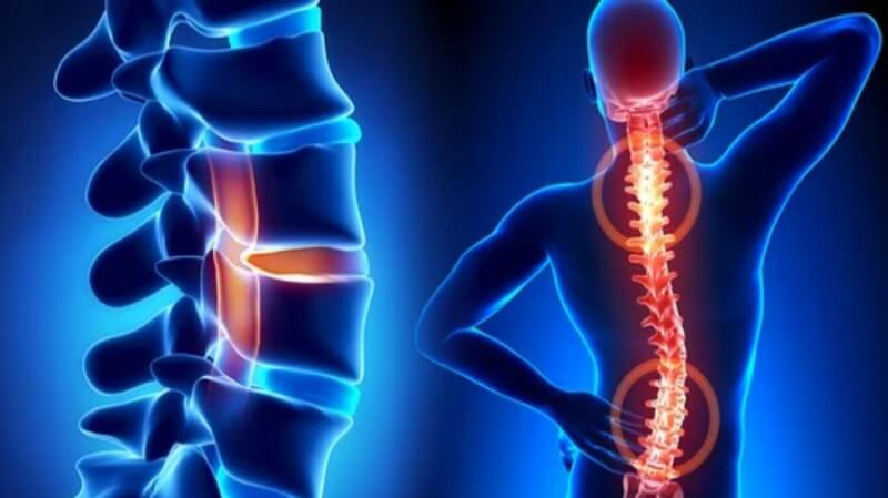 Spine Disorders: Types, Symptoms, Causes, and Treatment